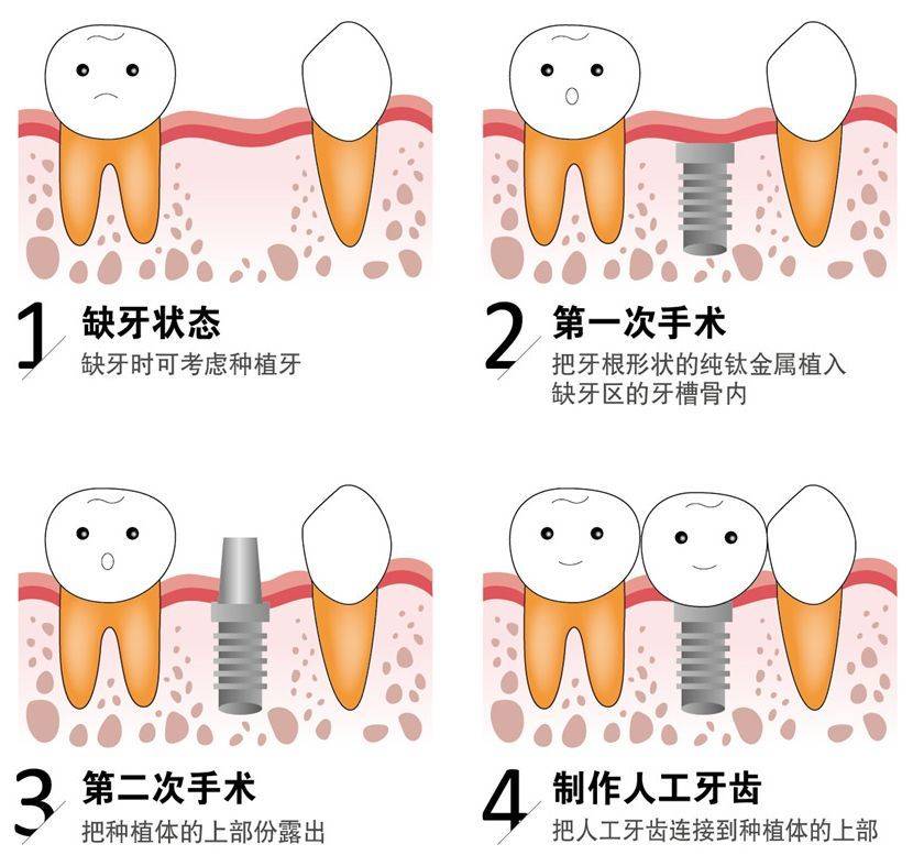 种植牙全面步骤指南